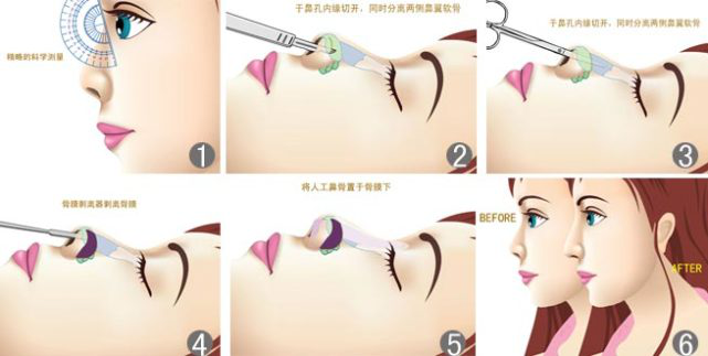 最新鼻部護理技巧，塑造完美鼻型的秘訣
