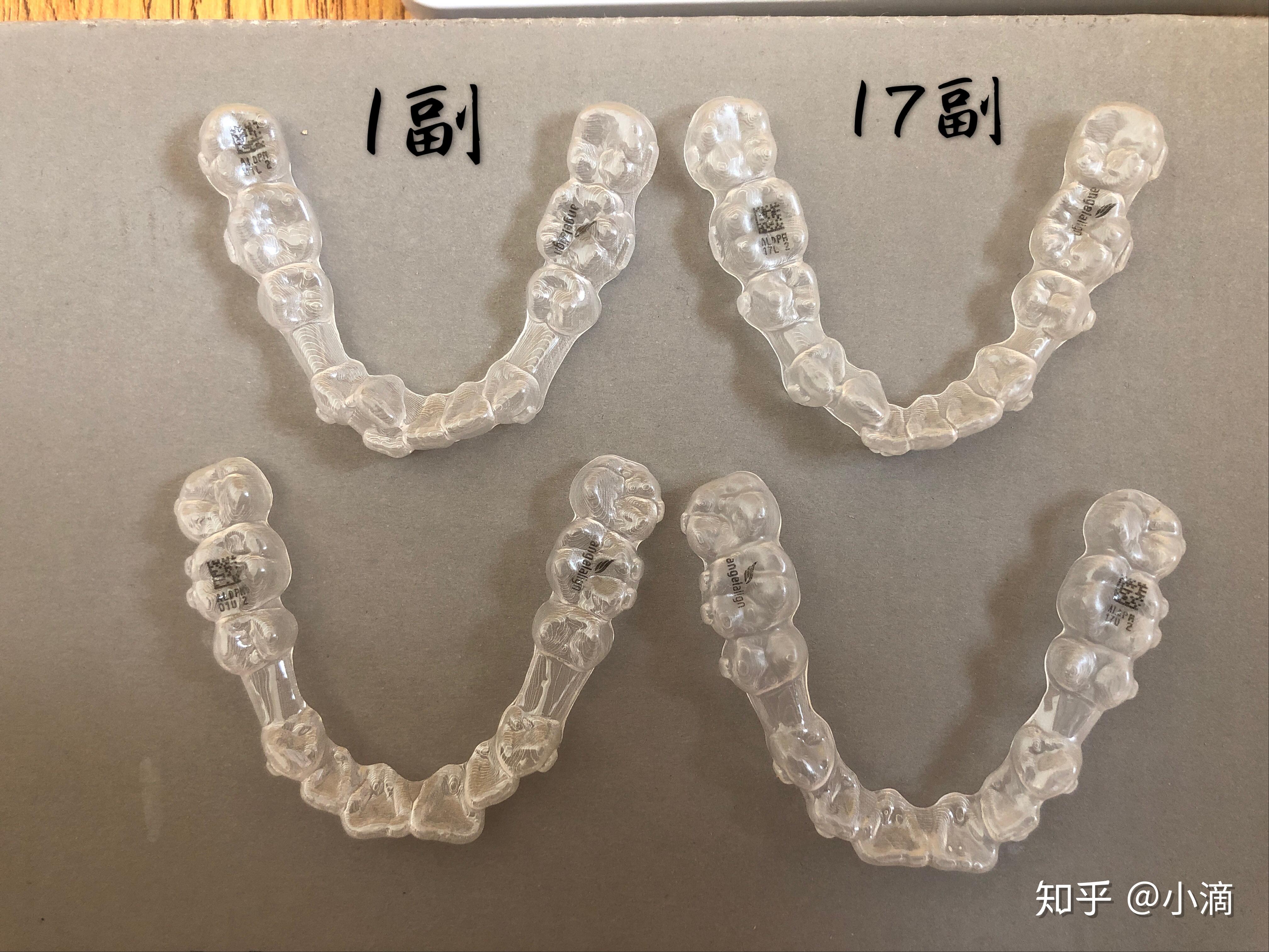 時代天使牙套價格揭秘，小巷中的美麗蛻變之旅啟動！