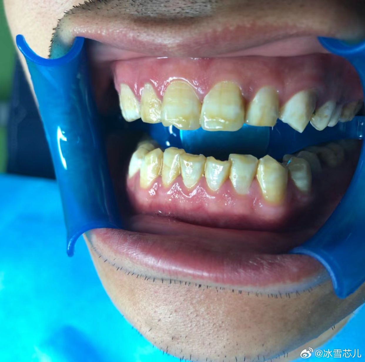 四環(huán)素牙貼面價(jià)格解析與比較指南